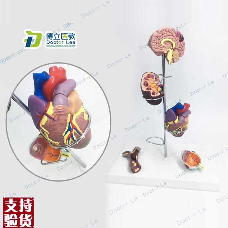 人体医学糖尿模型o并发症大脑心脏胰腺神经元足内外科