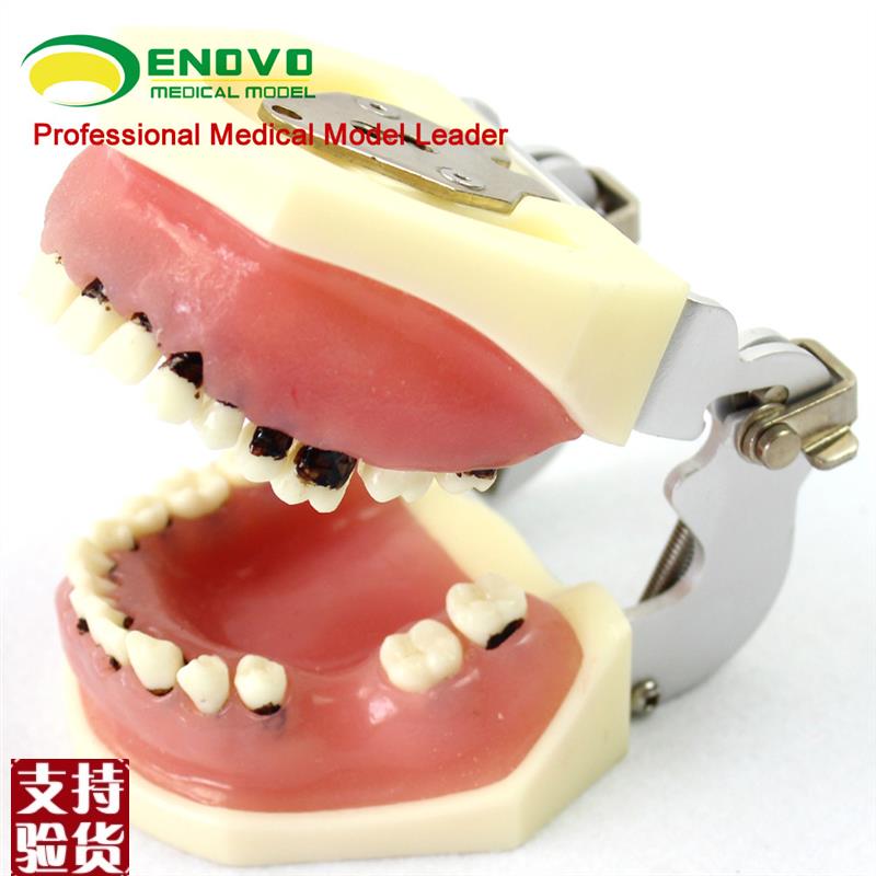 颐诺正品口腔h重度牙周病学模型牙结石刮治牙龈缝合模型分瓣术