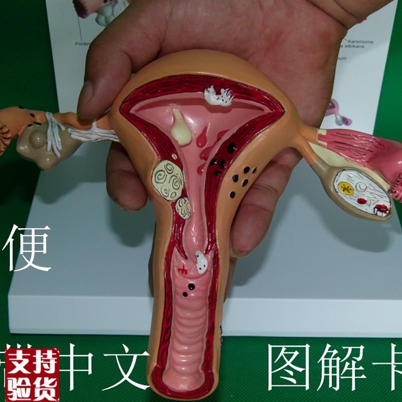 子宫卵巢病理病变模型生殖科A医药礼品模型女性子宫阴道模型