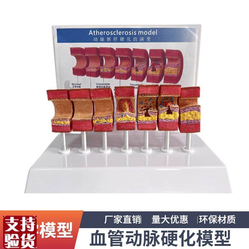 7节动脉粥样硬i化模型血管血栓栓塞演示模型人体血管模型医用教具