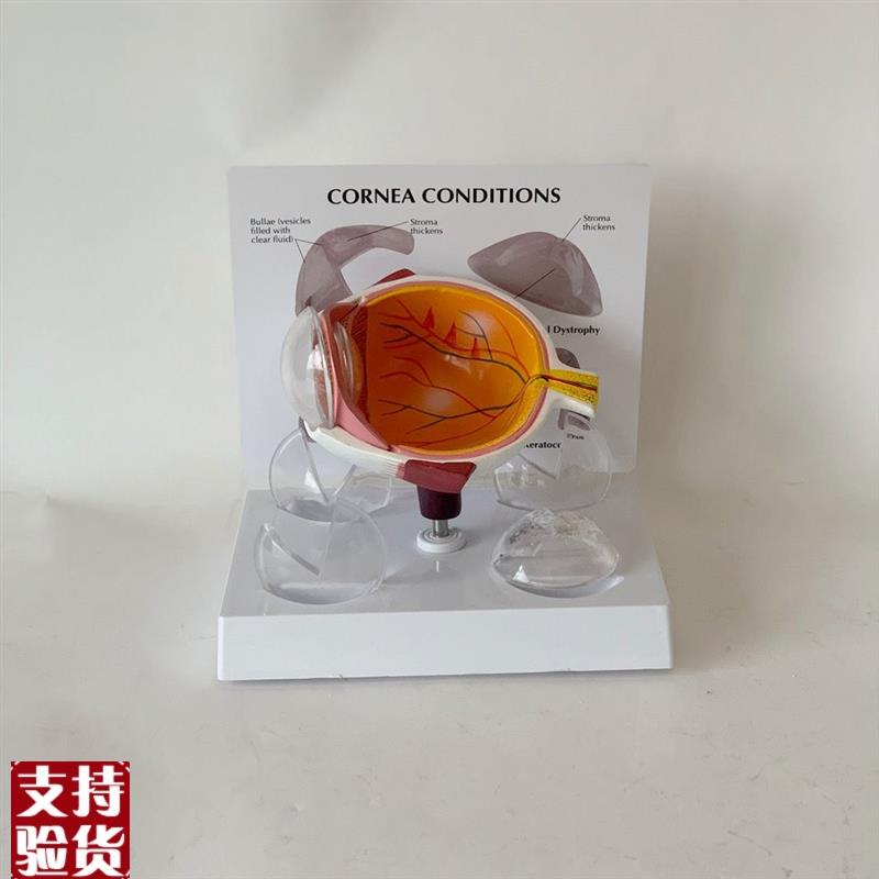 角膜模型视力感觉器官白内障青光眼视网膜眼O底眼科教学医患医药