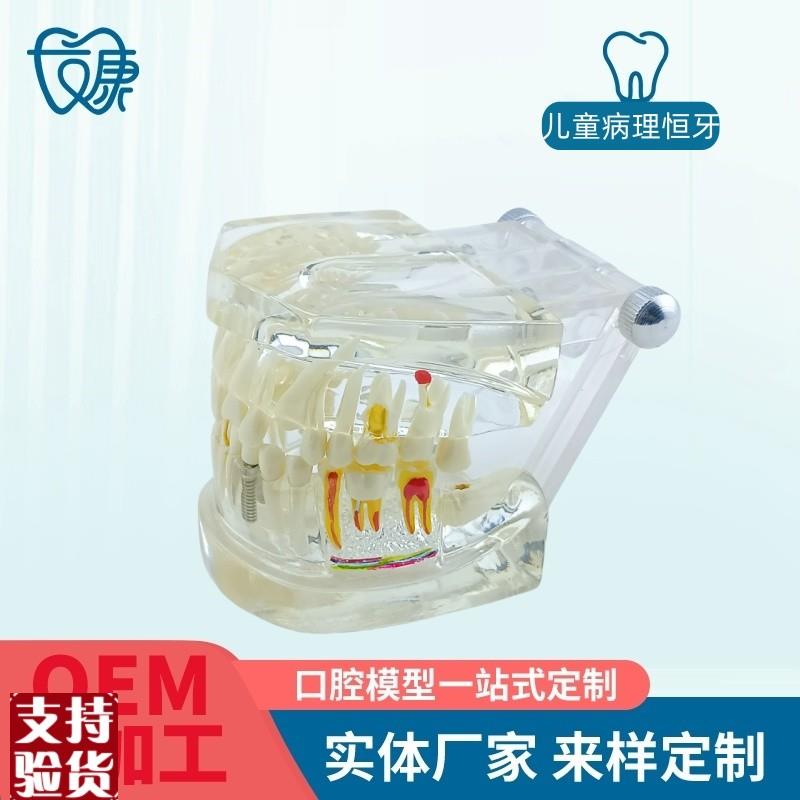 牙齿模型病理修复可拆卸正畸口腔病理牙模型牙V科医患活动沟通
