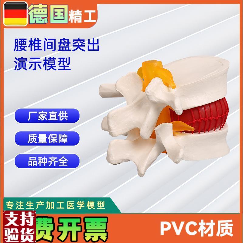 椎间盘模型人体腰椎p突出病理演示模型11*10*7.6CM
