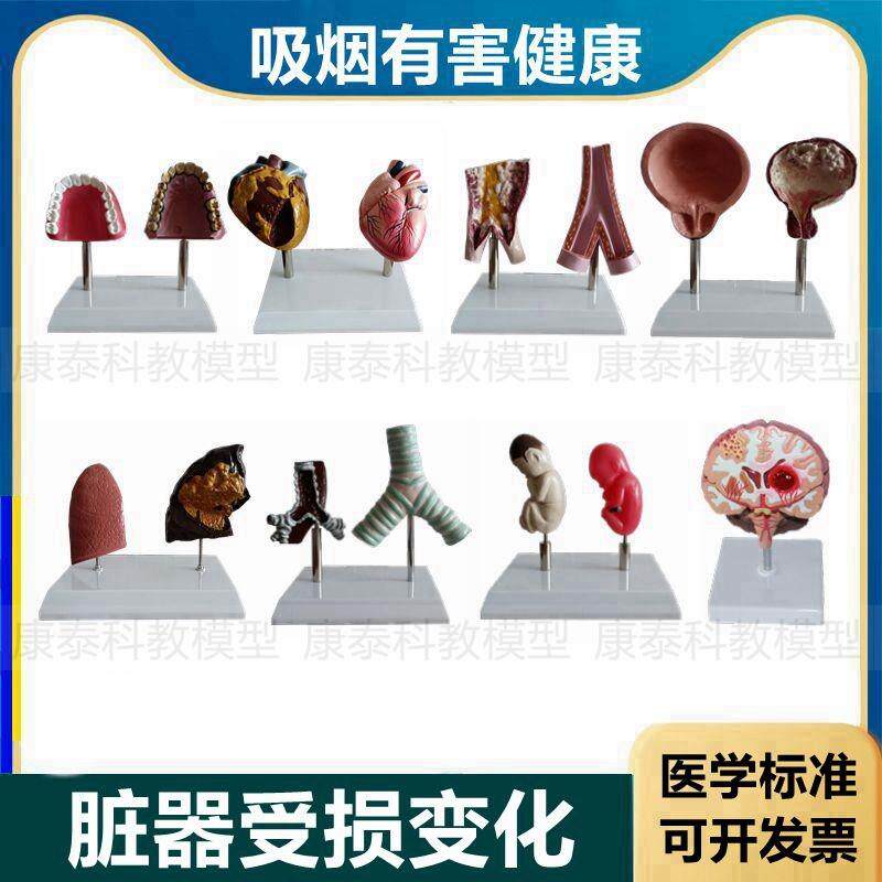 心脏模型病理正常对比吸s烟有害心血管肺气管口腔牙齿戒烟警示教