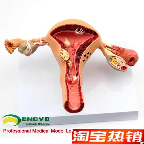ENOVO颐诺人体女性子宫卵巢模型子宫J疾病生殖科妇产科医患沟通讲