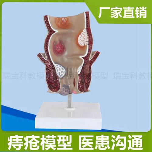 人体结肠模型大肠标识病理肠道突出肉H扭转老人盲肠阑尾直肠肛周