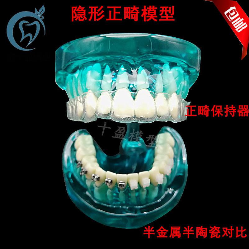 牙科隐形正畸模i型正畸保持器示范正畸半金属半陶瓷托槽对比包邮