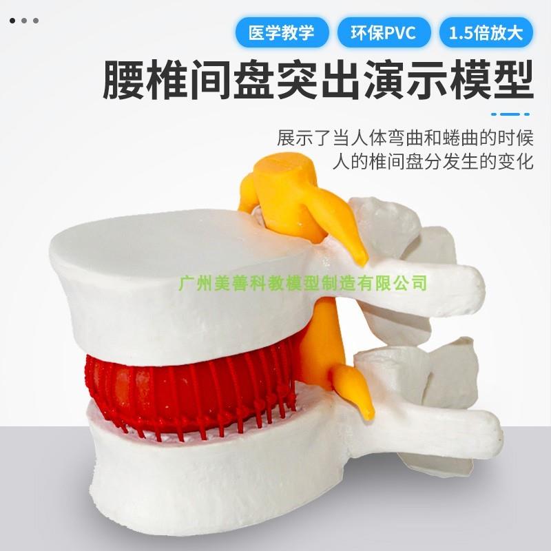 病态椎间盘模型医学人体腰椎突出脊柱G脊椎骨病理演示关节标准模