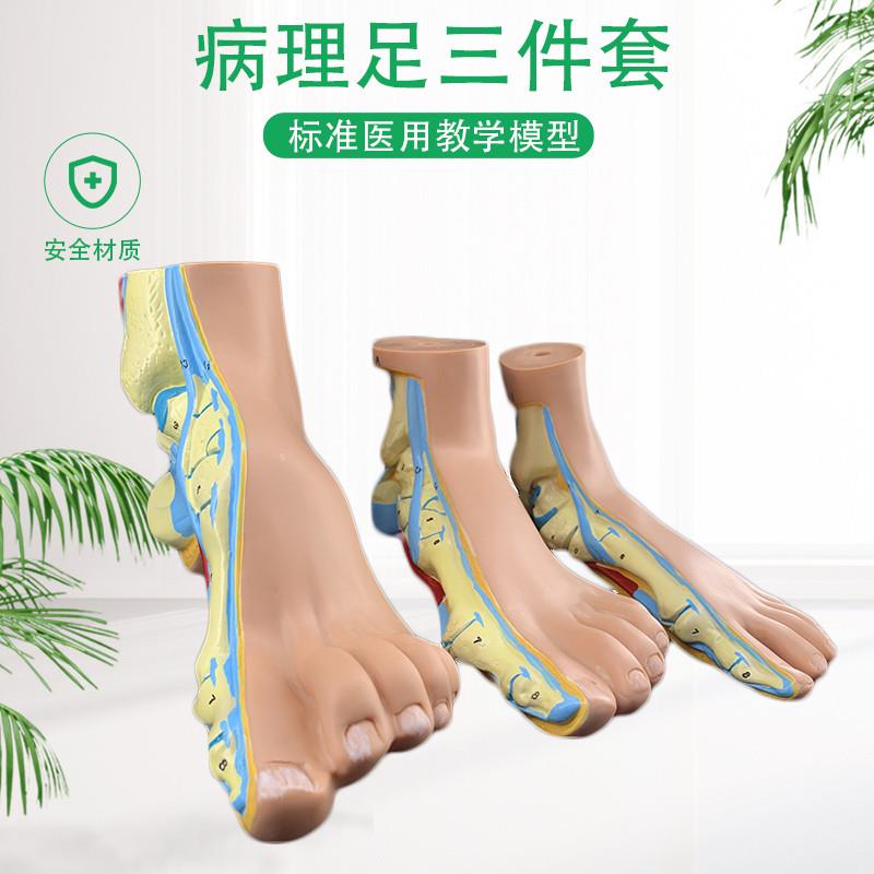 正常足弓形足高弓足o模型脚关节模型爪形足脚部模型解剖医院