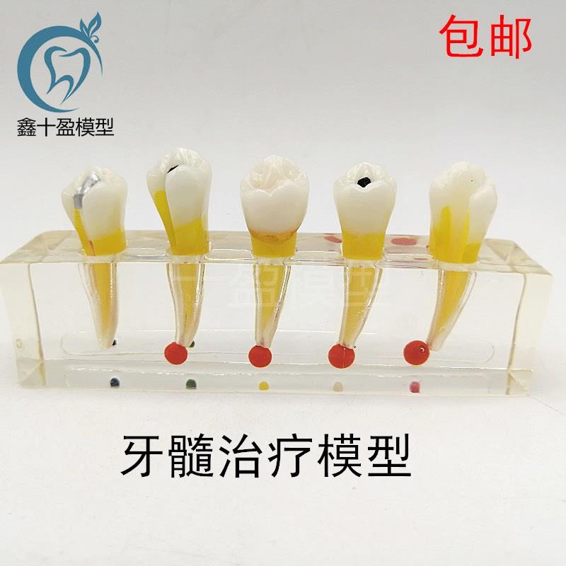 牙科口腔牙齿模型牙髓修复模型前磨A牙牙体蛀牙根管龋坏M4007-2
