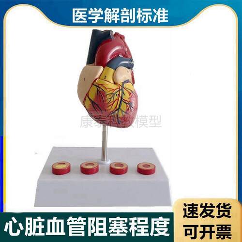 心血管模型冠状动脉粥样阻塞硬化B程度狭窄脂肪斑块内膜栓子医患