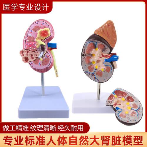 人体肾解剖模型正常肾部模型,病理肾G脏模型专业内脏器官医学教具
