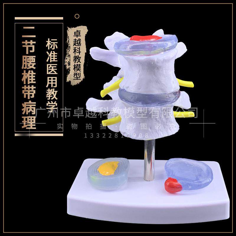 椎间盘脱出腰脊柱模型脊椎骨骼解剖G模型腰椎模型关节模型骨骼