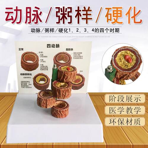 血管/堵塞动支脉粥样p/硬化心血管动脉/硬化模型血管病理模型血栓