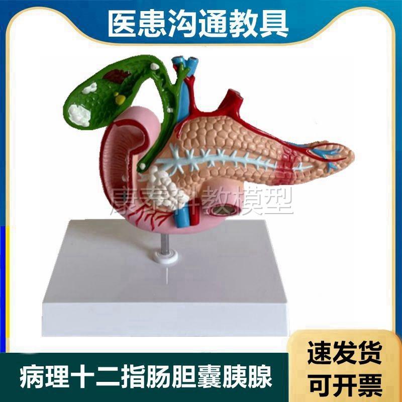 十二指肠胆囊胰腺模型病理医患教育医药促销礼Q品人体消化内脏器