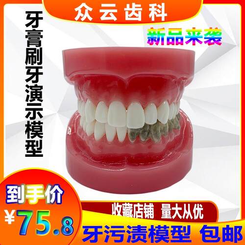 口腔牙科牙d污渍模型牙科刷牙直播展示坏外购牙污渍牙渍道具仿真