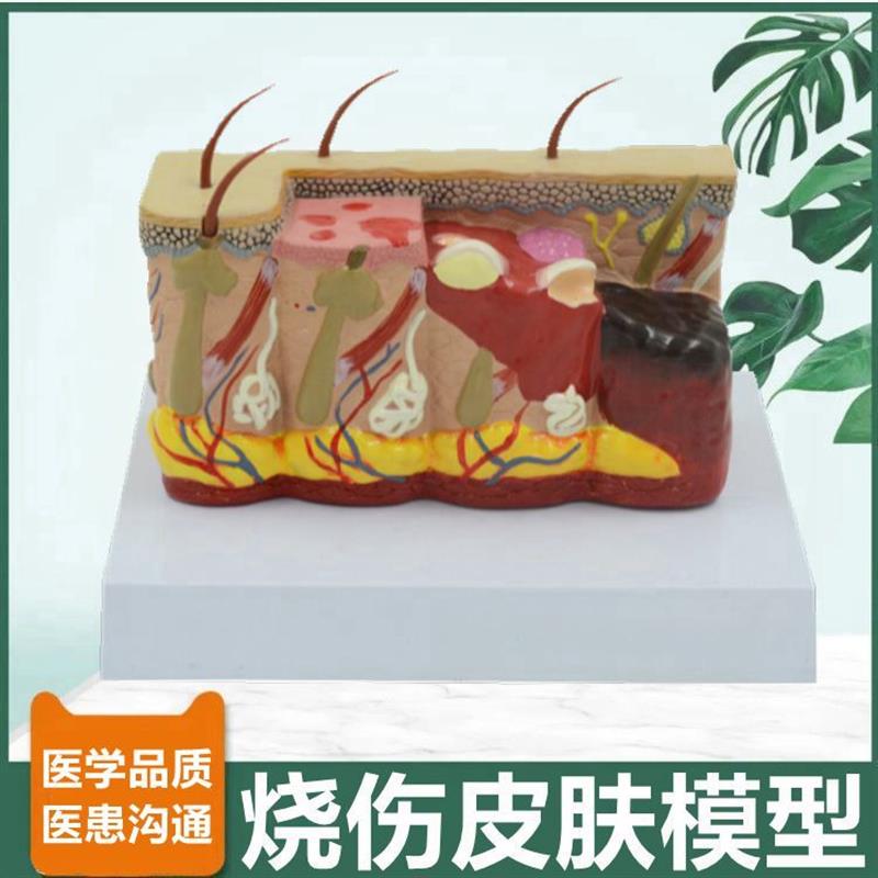 皮肤烧伤模型病理变m化皮肤科医患沟通螨虫叮咬过程人体皮肤微整