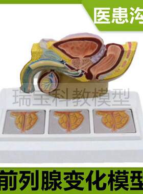 前列腺比较模型病理变化增u大生肥尿道狭窄男科医患中老年人前列