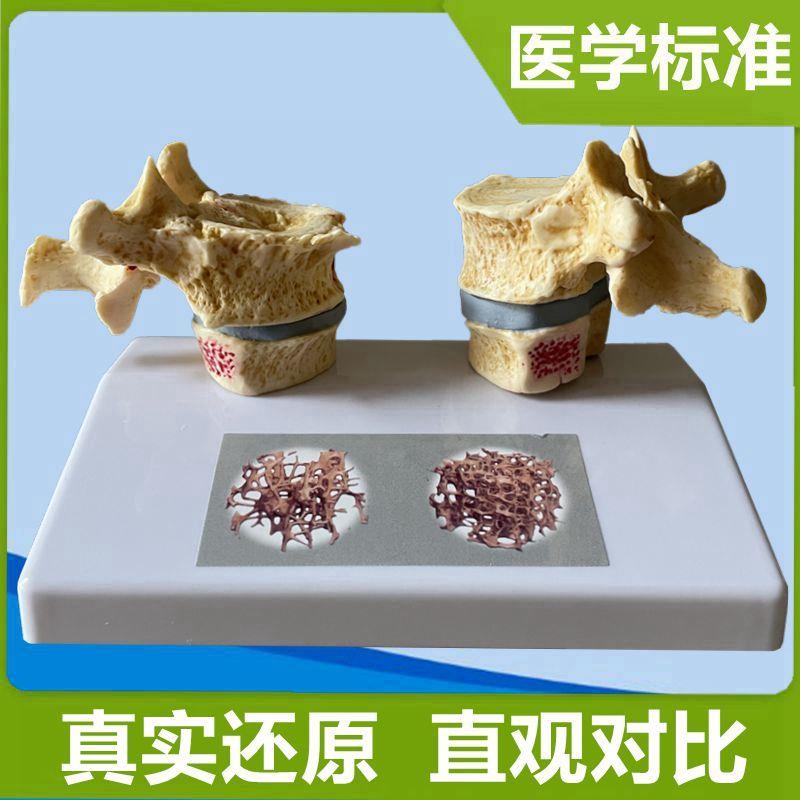 脊椎骨质疏松模型老年人骨u骼仿真股骨头密度腰椎变形劳损医患礼