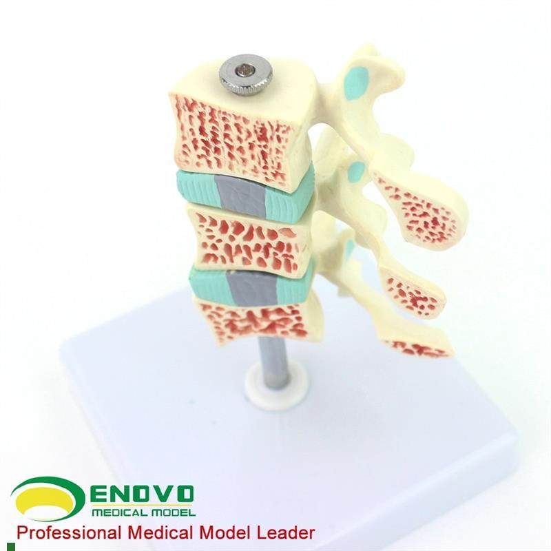 ENOVO颐诺人体骨n质疏松症模型关节骨质疏松模型人体椎间盘腰椎模,文具电教/文化用品/商务用品,教学标本/模型,淘宝优惠券,粉丝福利购,淘宝优惠卷
