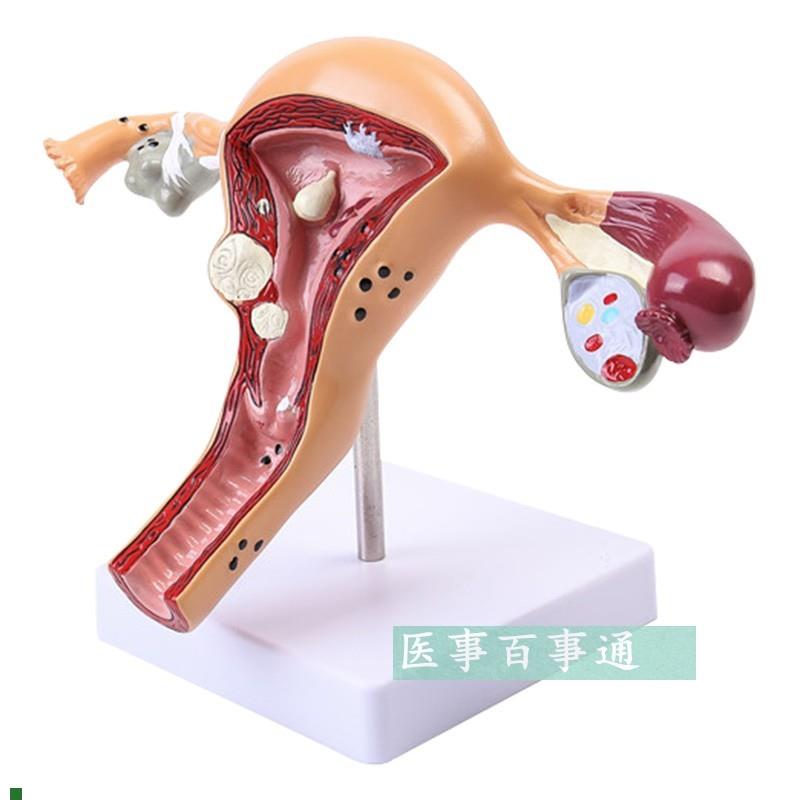 人体子宫模型生殖科妇科医用y演示模型女性子宫阴道模型病理子宫