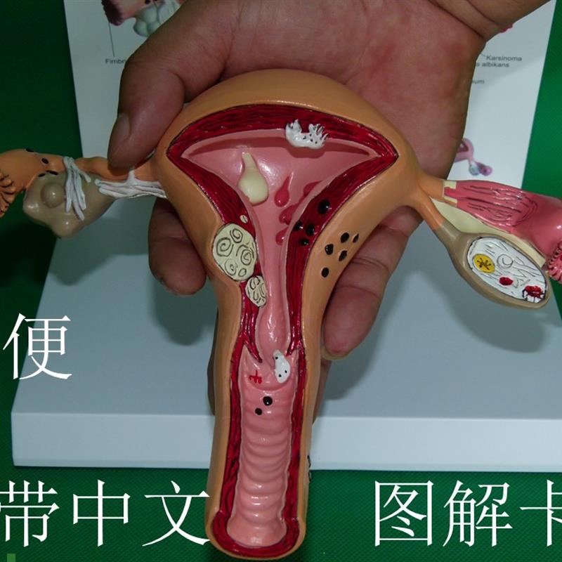 子宫卵巢病理病变模型生殖科医药礼品模型R女性子宫阴道模型