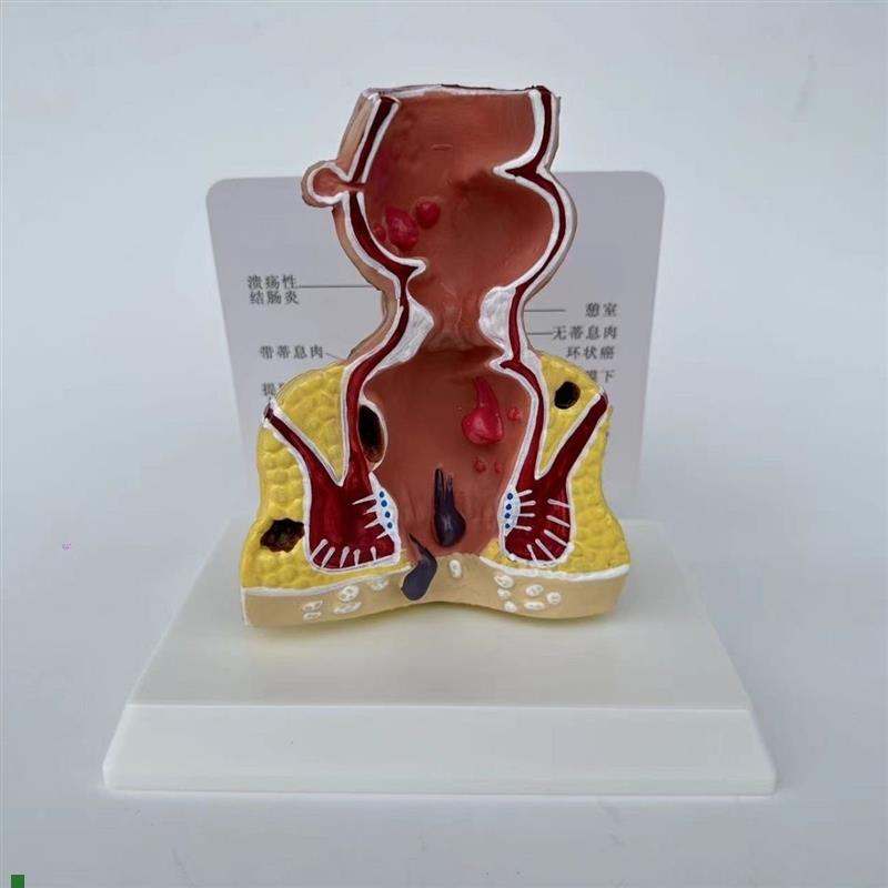 人体直肠模c型肛管裂开痔内外突出瘘管消化道结肠大肠医患病理沟