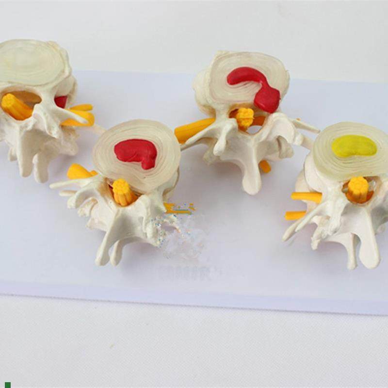 人体四阶段病态正常腰椎比较病F变骨骼标本模具病理模型