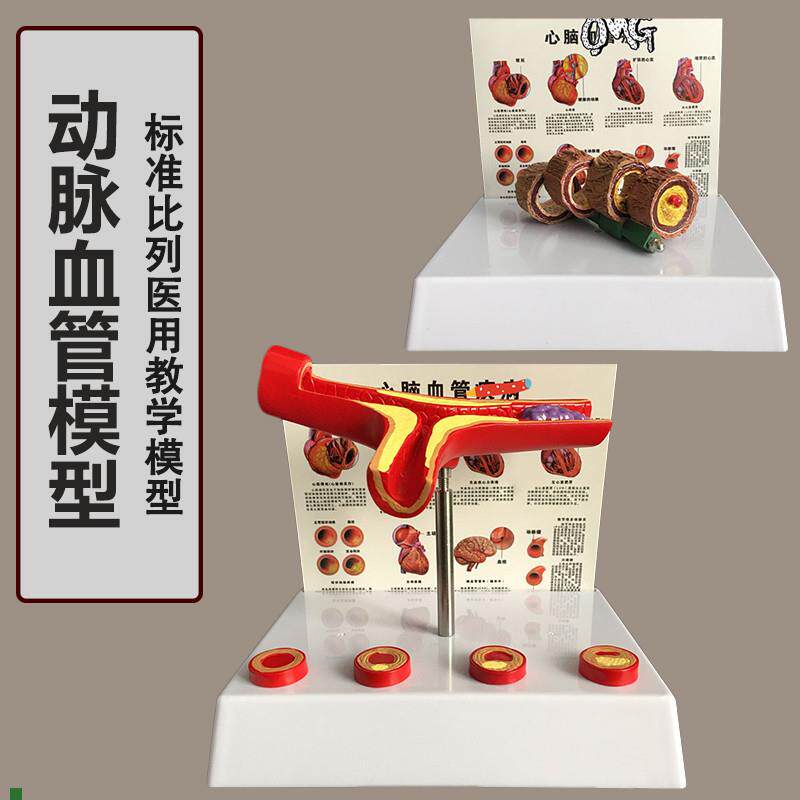 人体支脉粥样形成模型血管模型血G液科动脉模型教学血管模型
