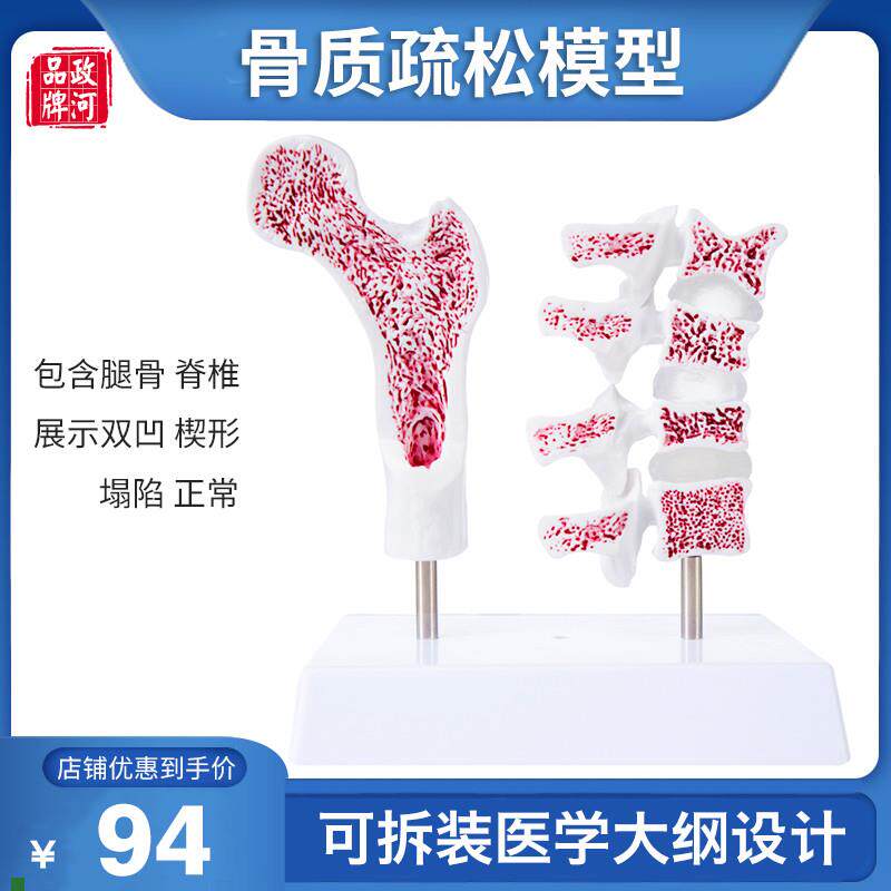 骨质疏松模型人体骨骼教学模型股骨头H脊椎双凹塌陷楔形病理病变