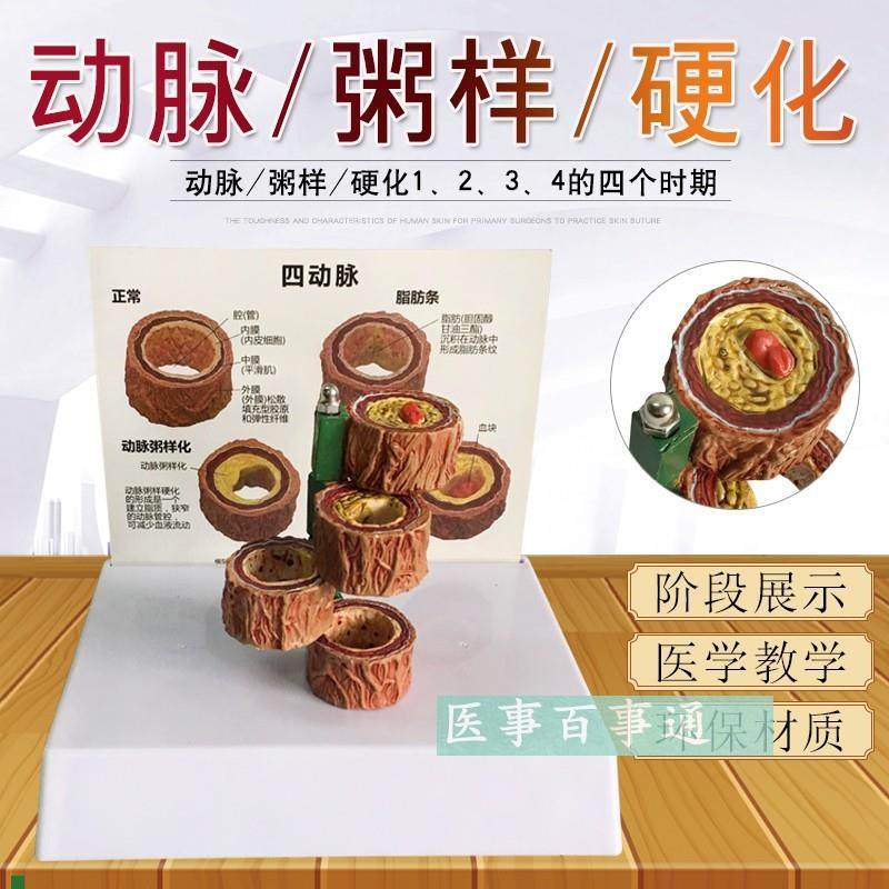 动脉11化模型带血栓模型血管模型形.成过程模型人体粥样化