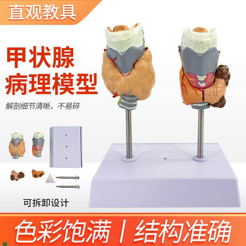 甲状腺病理f模型病态喉头解剖模型甲状腺病变模型甲状腺模型