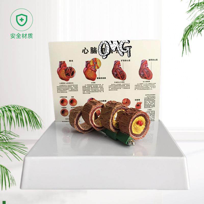 教学仿真血管模型j活动血管阻塞模型血栓病变标本4阶段性动脉O硬