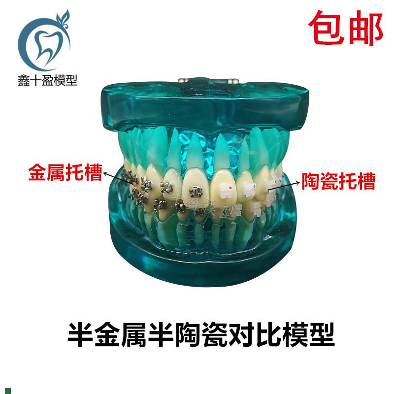 牙科正畸牙模带金属陶瓷托槽牙模型医患沟通教学口腔.牙模型包邮