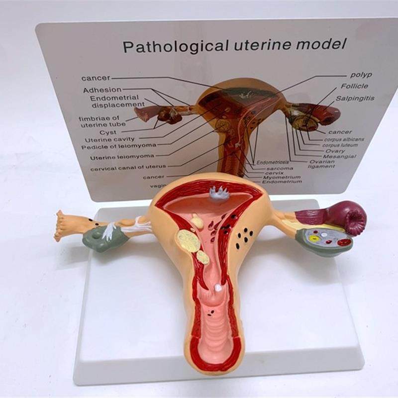 人体女性生殖子宫解剖病理模型阴道卵巢教学P模型妇科生殖科教具