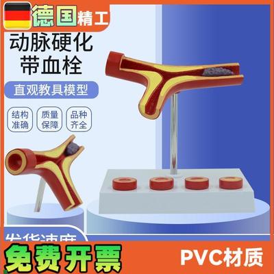 人体心血管f动脉硬化解剖模型老年冠心病血栓教学心内科