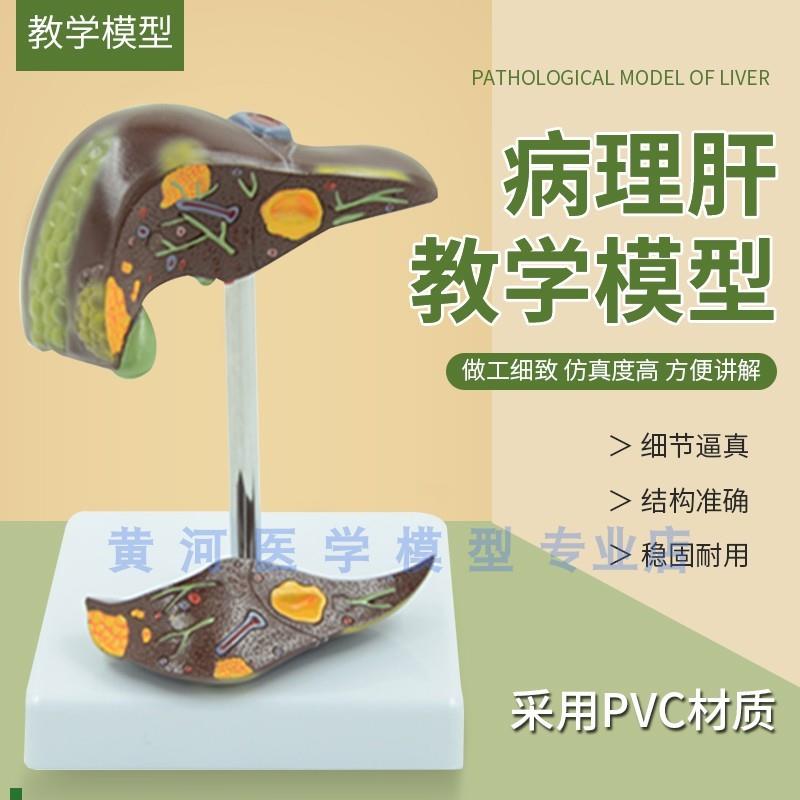 黄河肝脏病理病理肝q模型结石胆模型医用脂肪肝演示病理胆囊