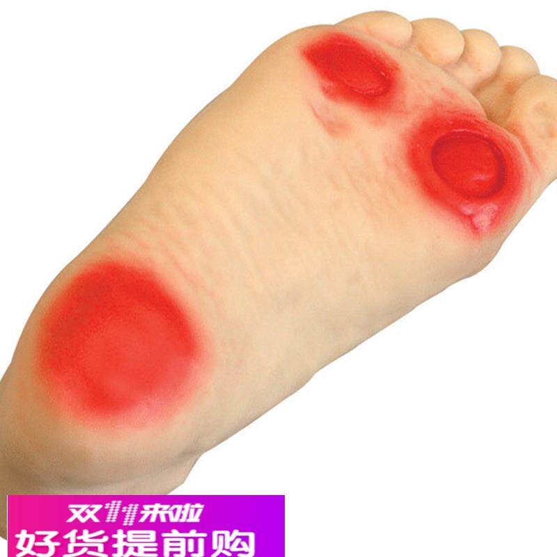 正品 高级糖尿病足护理模型 足部病变护理模型 畸形脚模具
