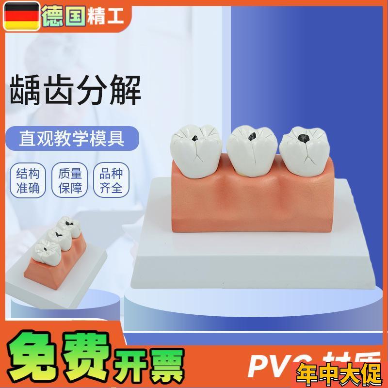 德国】龋齿病分解解剖模型牙齿模型口腔牙保健护理X模型牙科牙齿