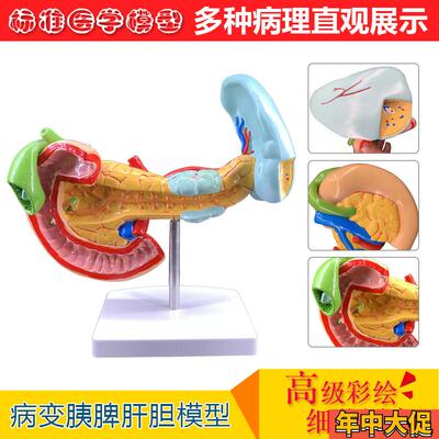 教学仿真病f变胰脾肝胆十二指肠模型病理胰腺标本胰脾肝胆解剖