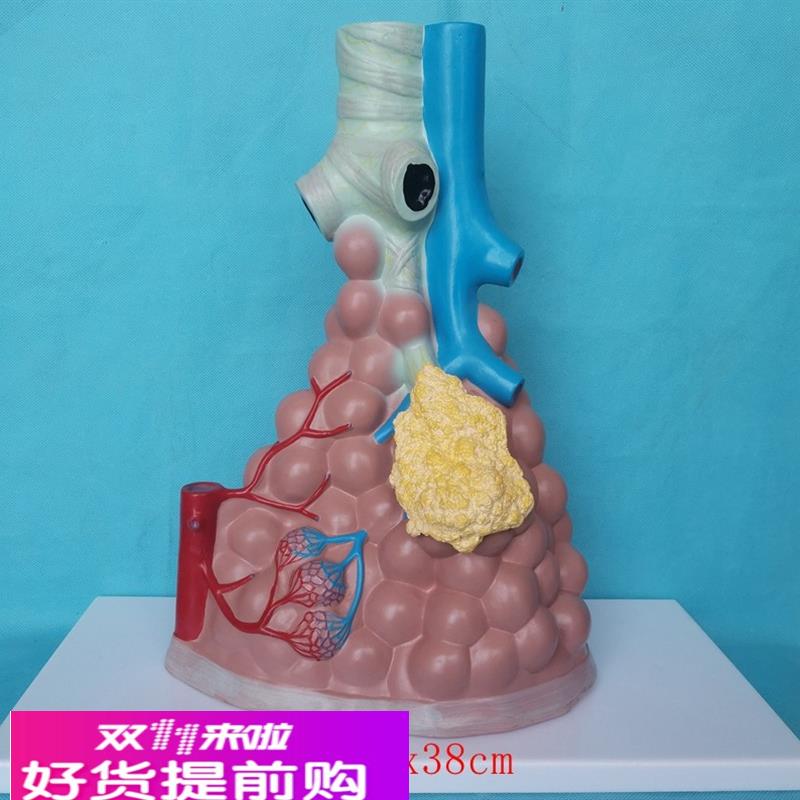 人体病理肺泡放大模型肺解剖内脏医用教学病理讲解展示