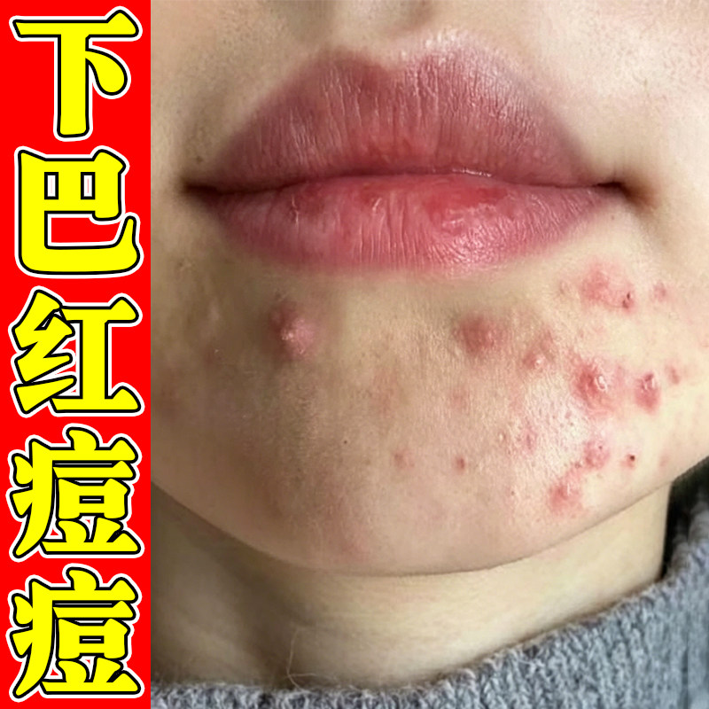 下巴长痘痘红肿脓包硬块疙瘩熬夜疼痛痘改善青春痘内分泌失调长痘