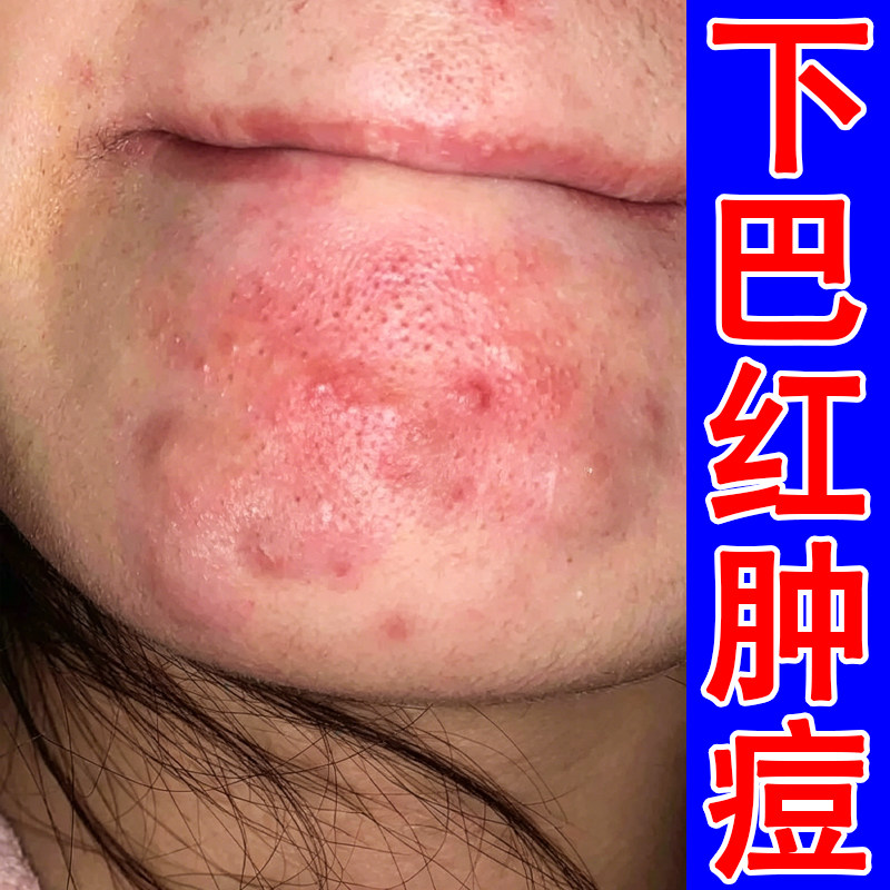 下巴起痘痘唇周长红肿疙瘩女生熬皮肤消毒护理（消）