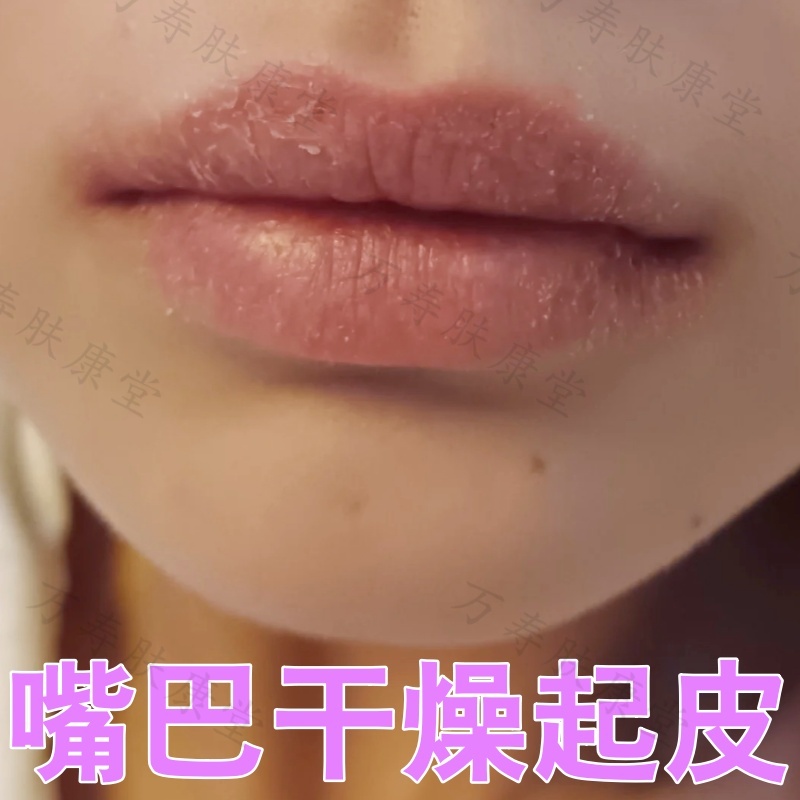 嘴巴干燥起皮脱屑性唇部炎嘴唇紧绷泛红病毒性感染红肿润唇膏外用