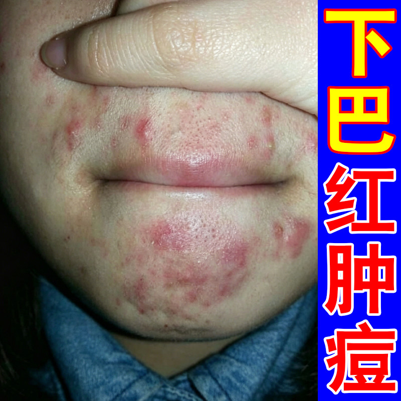 下巴长痘痘冒痘腮边闭口白头油脂堆积改善粗糙颗粒感红肿脓包疙瘩