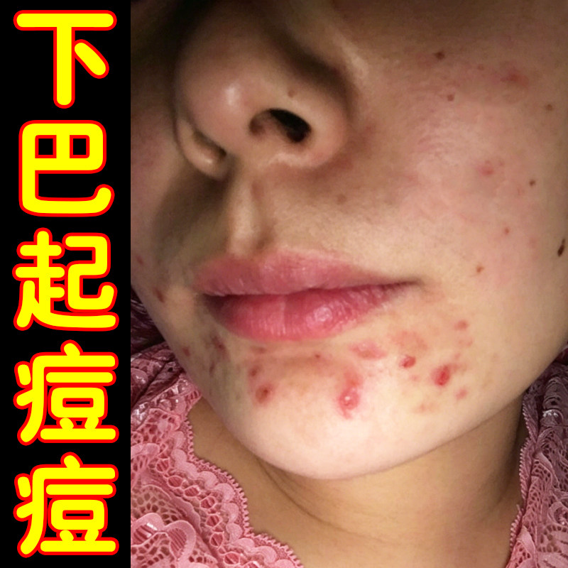 下巴脓包痘闭口粉刺冒白尖红疙瘩皮肤消毒护理（消）