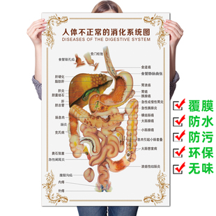 人体不正常的消化系统挂图 人体系统解剖知识挂画 医院科室墙贴画