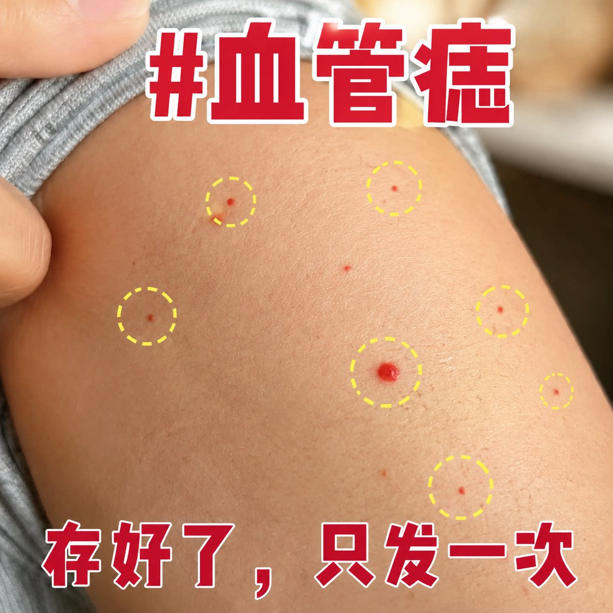 血管瘤血管痣樱桃状身上胳膊上手臂小红点红痣破损创面护理凝胶YU图片