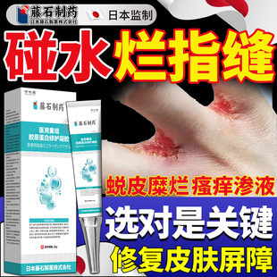 洗碗碰水手指缝溃烂痒烂手丫皮炎皮肤瘙痒开裂专用搭软膏药贴BF