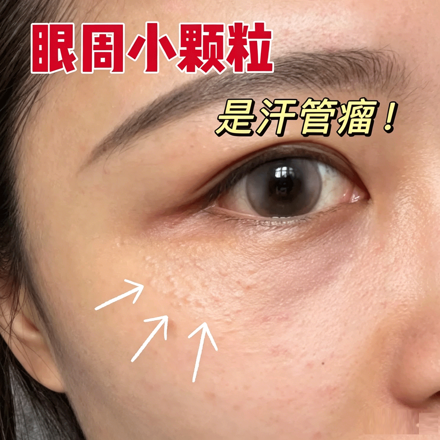 汗管瘤眼部去除神器搭专用膏药贴去眼周消除小疙瘩脂肪粒扁平疣YU